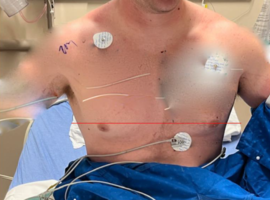 Acute Pectoralis Major Rupture Repair at the Myotendinous Junction with Dermal Allograft Augmentation: A Surgical Technique and Review of the Current Literature