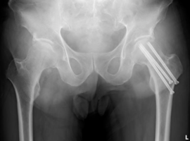 Screw Exchange Technique Following Internal Fixation Failure in a Displaced Femoral Neck Fracture: A Case Report