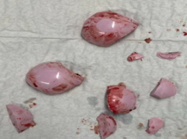 Atraumatic Breakage of a 4th Generation BIOLOX Delta Ceramic Head in Total Hip Replacement: A Case Report Atraumatic Breakage of a 4th Generation BIOLOX Delta Ceramic Head in Total Hip Replacement: A Case Report