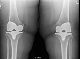 An Uncommon Complication: Common Peroneal Nerve Palsy After Medial TKA