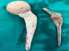 Low-Cost Customized Cement Hip Spacer: A Surgical Technique Utilizing Low Contact Dynamic Compression Plate