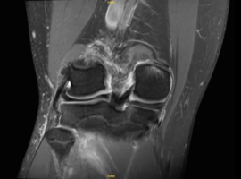 Isolated Posterior Medial Meniscal Root Avulsion in a Skeletally Immature Athlete: A Case Report
