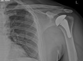 Reduced Humeral Component Retroversion as a Preventive Strategy to Avoid Recurrent Posterior Instability in Seizure Induced Posterior Dislocations with Severe Bone Loss Reduced Humeral Component Retroversion as a Preventive Strategy to Avoid Recurrent Posterior Instability in Seizure Induced Posterior Dislocations with Severe Bone Loss