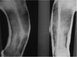 A Rare Case Report of the Fibula in Patient with the Treatment for Chronic Osteomyelitis of the Right Tibia