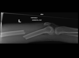 Femoral Shaft Fracture with Ipsilateral Knee Dislocation and Popliteal Artery Occlusion: A Case Report