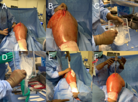 Use of Dalbavancin in the Treatment of Infected Bone Nonunion: A Report of Two Cases Use of Dalbavancin in the Treatment of Infected Bone Nonunion: A Report of Two Cases