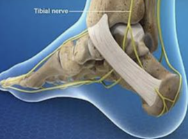 Tibial Nerve Injury from Intraoperative Neuromonitoring Needle Electrode During Cervical Disc Arthroplasty: A Case Report Tibial Nerve Injury from Intraoperative Neuromonitoring Needle Electrode During Cervical Disc Arthroplasty: A Case Report