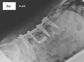 Treatment of Degenerative Disc Disease with Lateral Lumbar Interbody Fusion and Catalyst Bone Graft: Two High-Risk Patients with Consistent Outcomes Across Levels Treatment of Degenerative Disc Disease with Lateral Lumbar Interbody Fusion and Catalyst Bone Graft: Two High-Risk Patients with Consistent Outcomes Across Levels