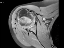 Percutaneous Labral Repair Using Nanoneedle in a Pediatric Baseball Player Percutaneous Labral Repair Using Nanoneedle in a Pediatric Baseball Player