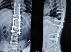 Spinal Fusion for Lenke Types Adolescent Idiopathic Scoliosis: A Case Report