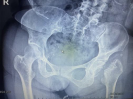 Acetabular Protrusion After Primary Dual-Mobility Total Hip Arthroplasty: A Rare Complication-Case Report and Systematic Literature Review Acetabular Protrusion After Primary Dual-Mobility Total Hip Arthroplasty: A Rare Complication-Case Report and Systematic Literature Review